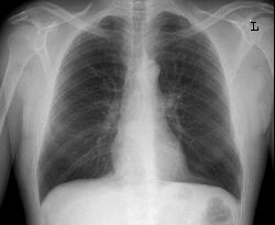 Anterior-posterior view chest x-ray image