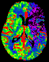 Colored CT image of the brain